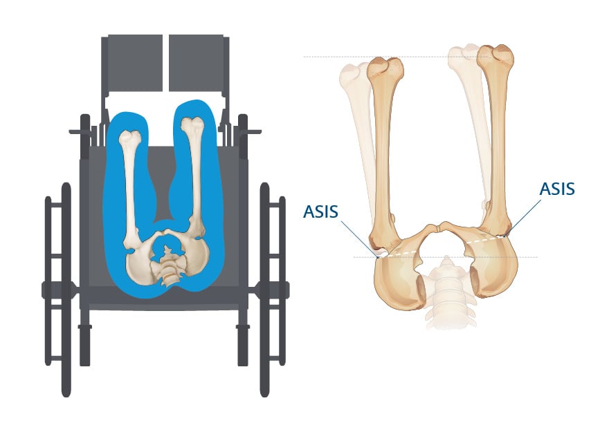 Pelvic Rotation Symptoms & Treatment Through Wheelchair Positioning